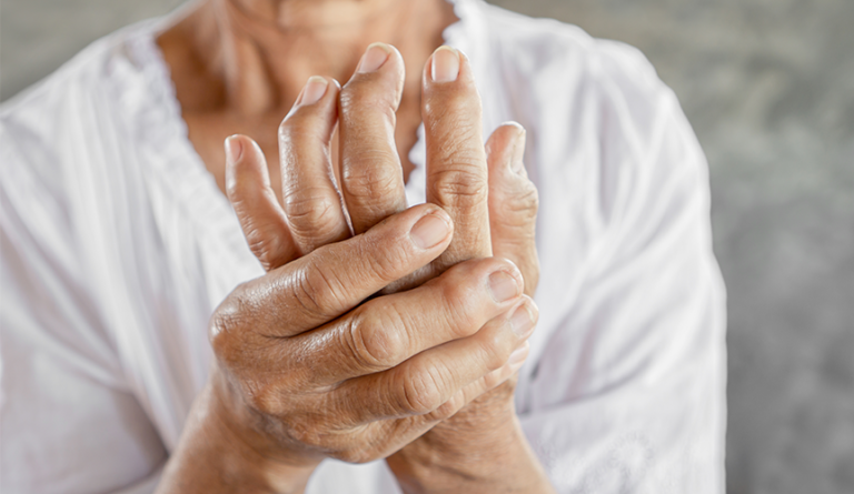 Hands of Old Man Showing Rheumatoid Arthritis
