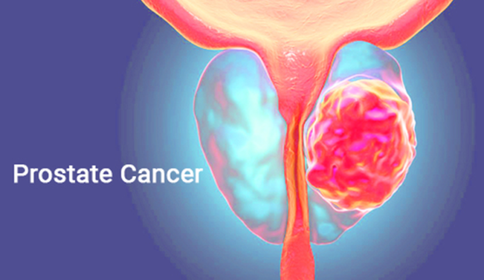 Advanced Prostate Cancer