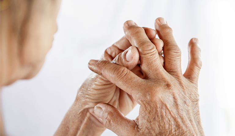 Psoriatic Arthritis: Symptoms, Medications, and Cure