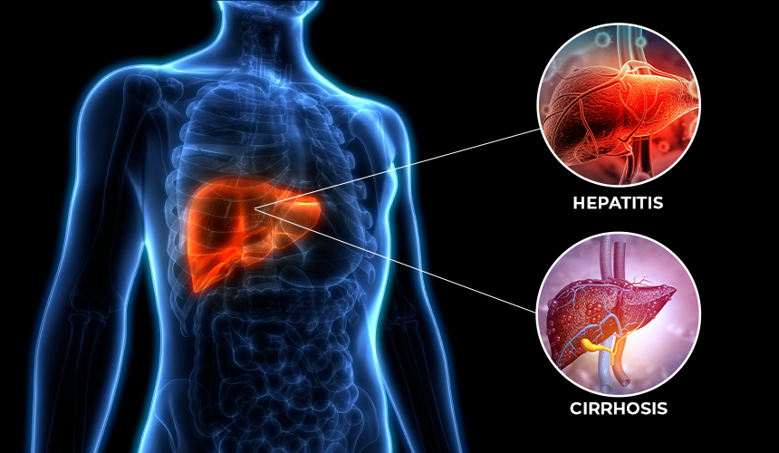 Hepatitis and Cirrhosis