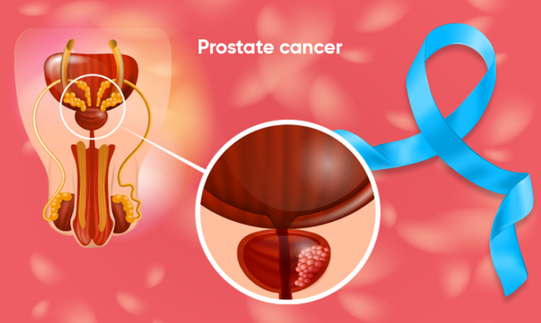 5 warning signs of prostate cancer