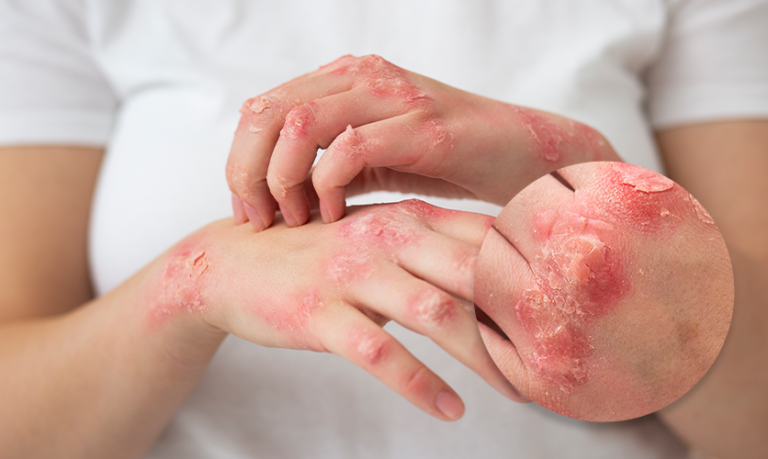 Can Psoriasis be Cured?