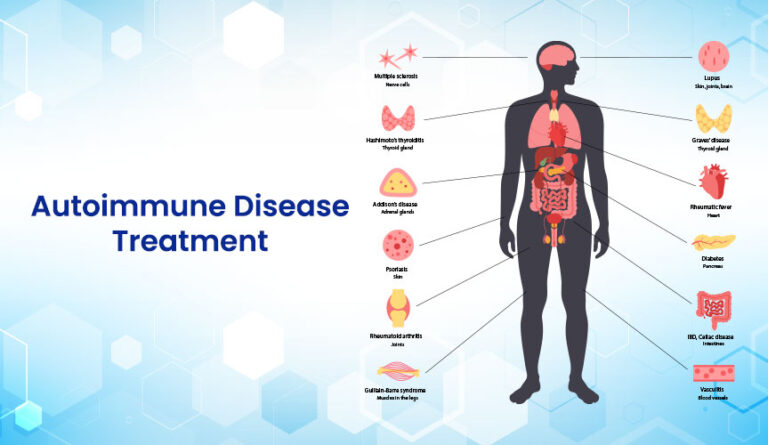 Autoimmune Disease Treatment
