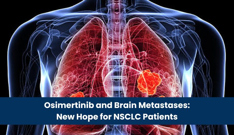 Osimertinib and Brain Metastases_ New Hope for NSCLC Patients